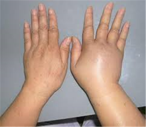 Bỏng nước sôi